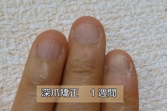 深爪爪噛み克服１週間