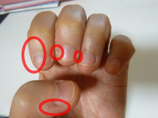 深爪克服７日目