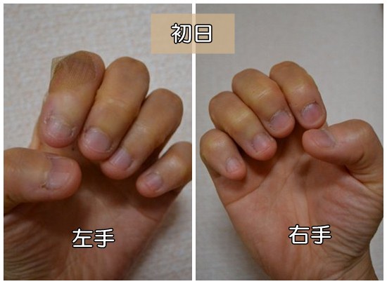 深爪克服治療１日目