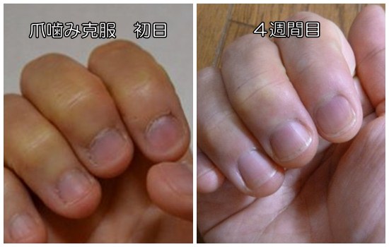 爪噛み克服初日と４週間目
