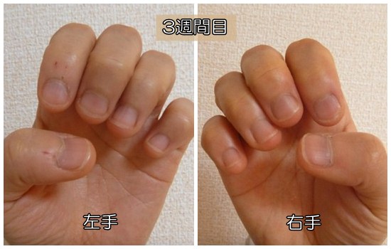 爪噛み克服３週間目