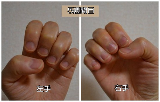 爪噛み　やめて５週間
