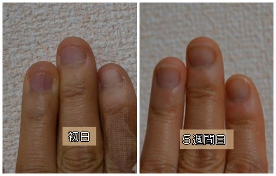 深爪５週間目２