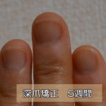 深爪爪噛み克服５週間