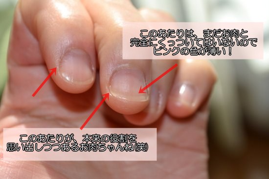 ５週間目の深爪の様子