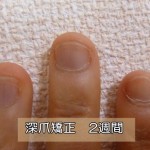 深爪・爪噛みやめて２週間