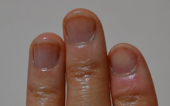 爪噛み克服10週間