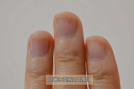 爪を噛む癖を辞めてから21週間目