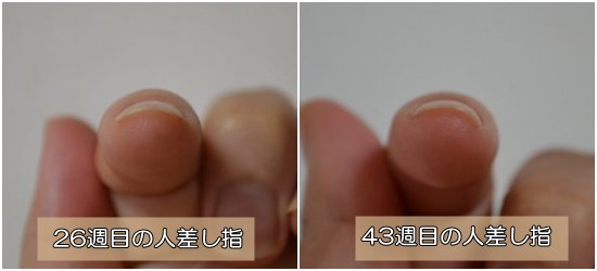 爪が扁平・まっすぐの悩み