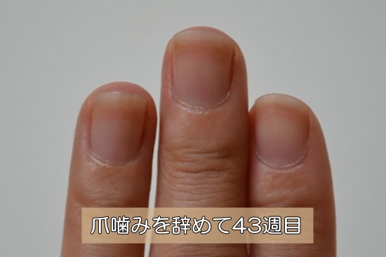 爪噛みを治し始めて43週目