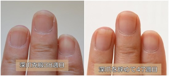 深爪の治療後38週と47週比較