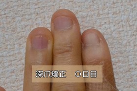 深爪をやめる自分で治す