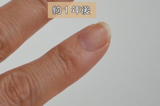 深爪　女子　1年後