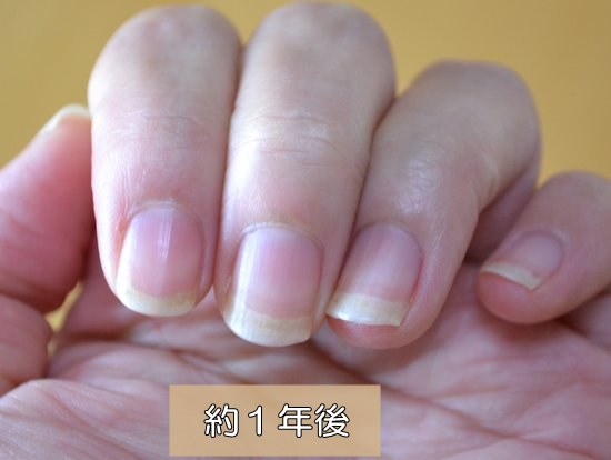 爪噛み女子　治して1年
