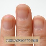 爪噛み治療51週目