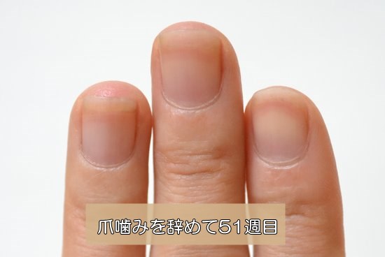 爪噛み治療51週目