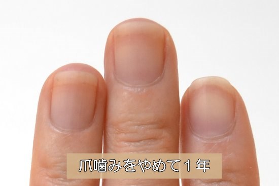 深爪を辞めて1年