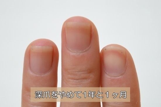 深爪を辞めて1年と1ヶ月