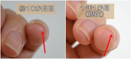 深爪を辞めて1年と1ヶ月