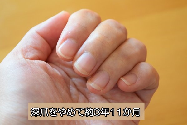 深爪をやめる　爪噛みをやめる　約４年後