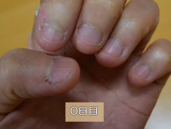 深爪女子　伸ばし始め０日目