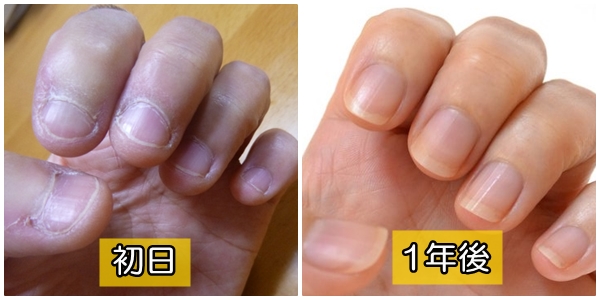 深爪治療　自力で　ブログ